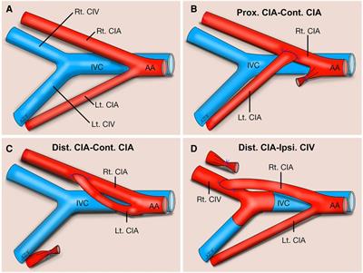 Three types of end-to-side microvascular anastomosis training models using rat common iliac arteries